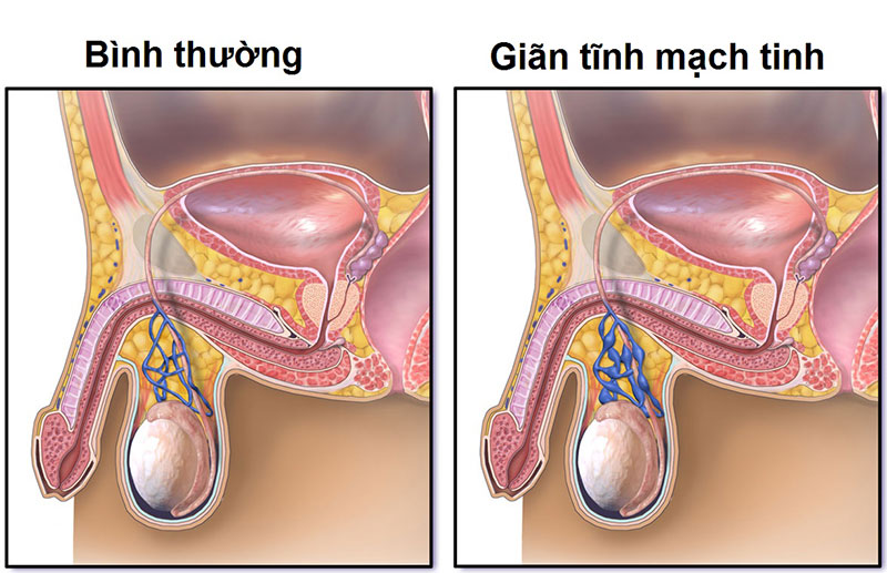 Giãn tĩnh mạch tinh