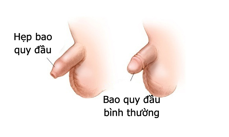 Hẹp bao quy đầu là gì