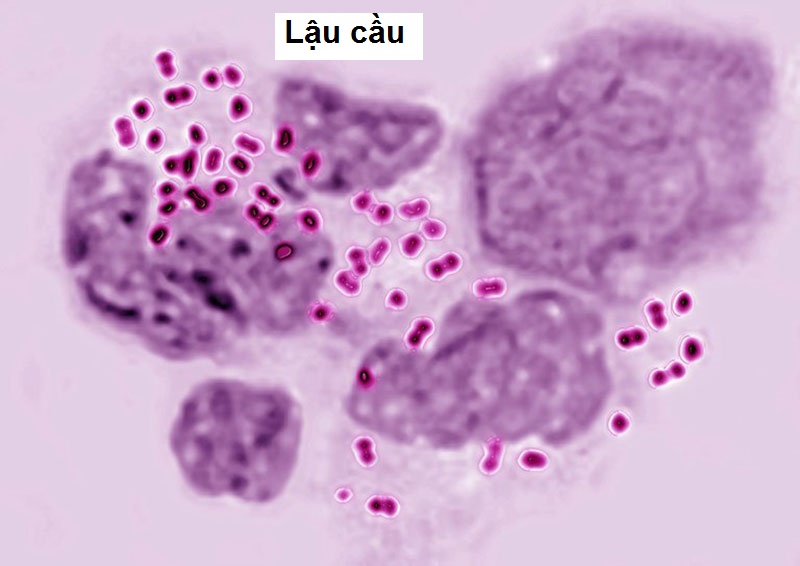 Viêm niệu đạo do lậu cầu