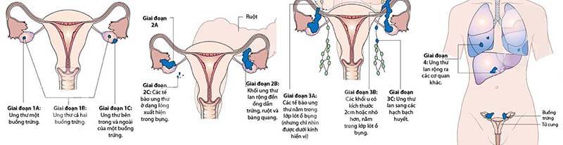 Giai đoạn của ung thư buồng trứng