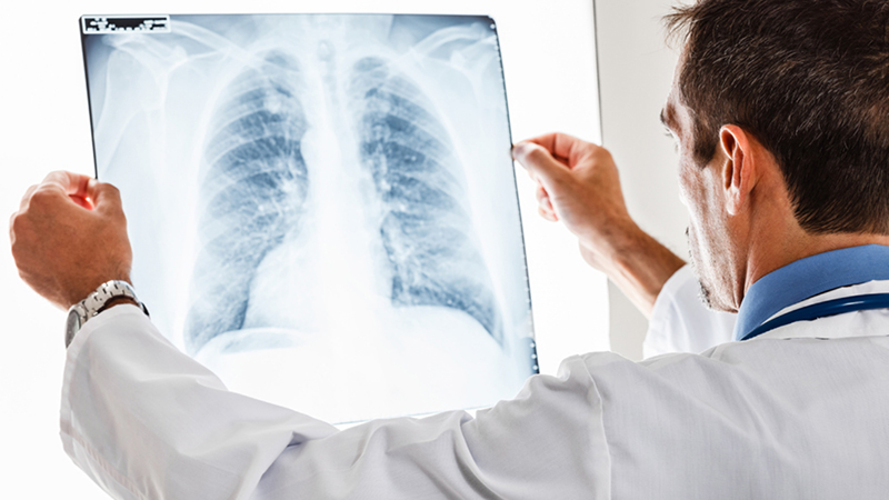 Phương pháp trị ung thư phổi mới tại Singapore