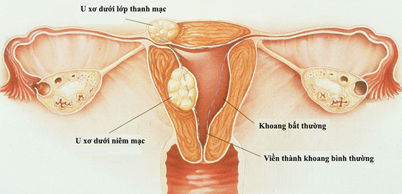 Điều trị tắc mạch u xơ tử cung không phẫu thuật