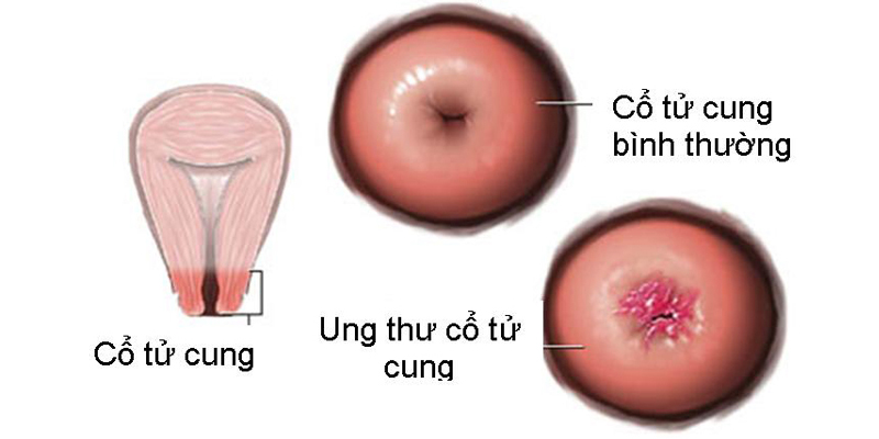 Điều trị ung thư cổ tử cung, hiệu quả 90% nếu phát hiện bệnh sớm