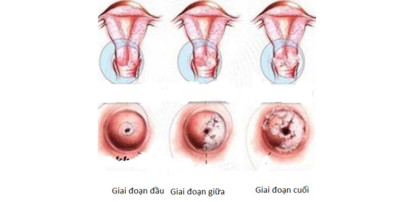 Ung thư cổ tử cung và các giai đoạn