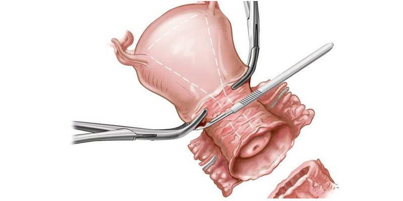 Cắt 1 phần hay toàn bộ tử cung
