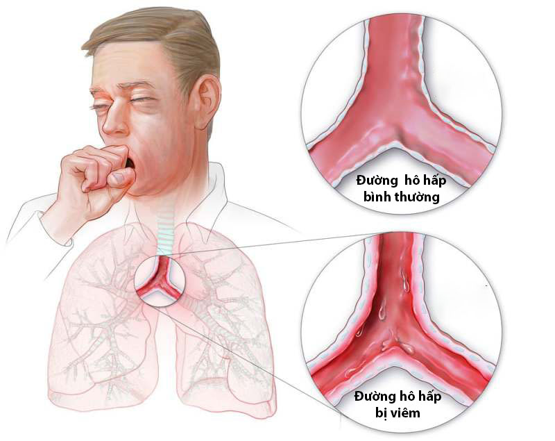 Viêm đường hô hấp dưới là gì, nguyên nhân, triệu chứng, điều trị