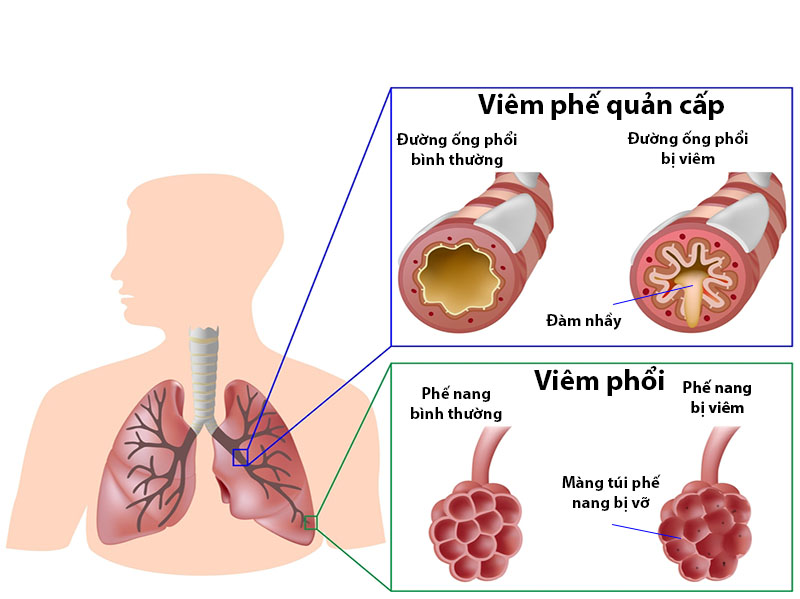 Viêm đường hô hấp dưới thường được chia ra làm hai loại