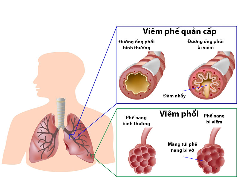 Viêm đường hô hấp dưới là gì, nguyên nhân, triệu chứng, điều trị