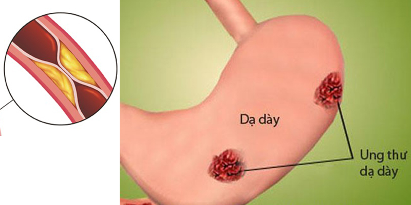 Các phương pháp điều trị ung thư dạ dày tiên tiến