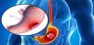Các phương pháp điều trị ung thư dạ dày tiên tiến