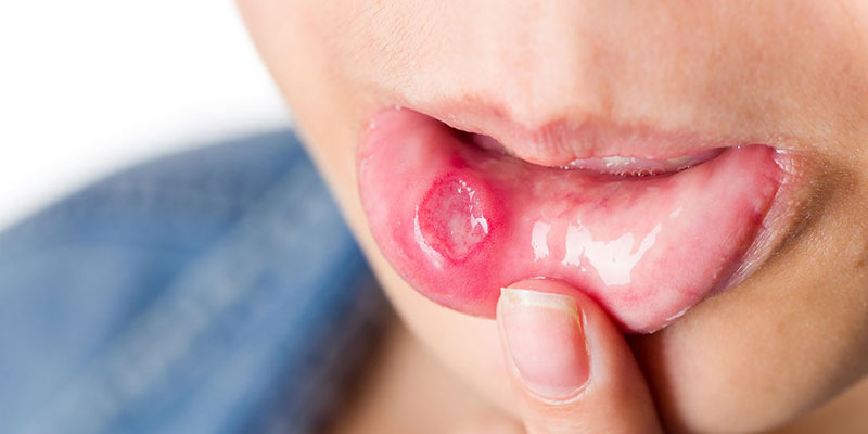 Cách chữa viêm loét miệng hiệu quả tại nhà