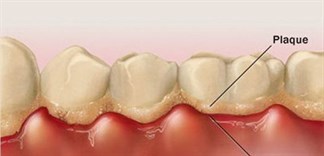 Triệu chứng của viêm nha chu là gì?
