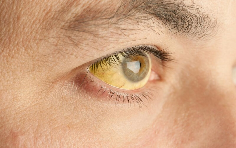 Vàng mắt, vàng da là dấu hiệu dễ nhận biết khi gan bị nhiễm dộc nặng