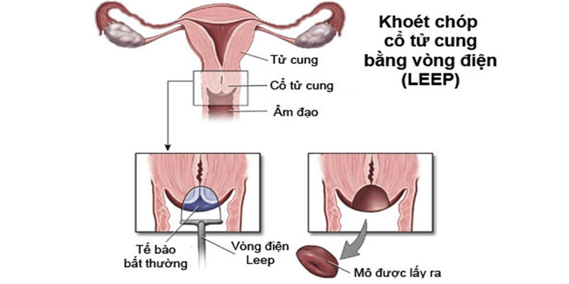 Thủ thuật LEEP điều trị viêm cổ tử cung