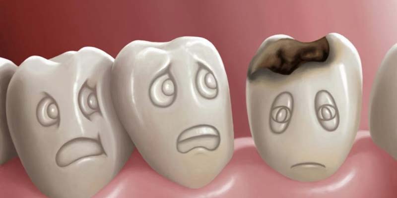 Khi vi khuẩn ăn các thức ăn giữa răng, axit sẽ được tạo ra từ đó gây sâu răng