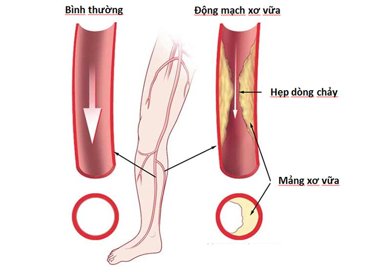 Động mạch ngoại biên