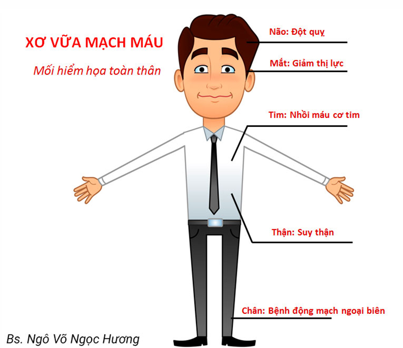 Nguy cơ động mạch ngoại biên