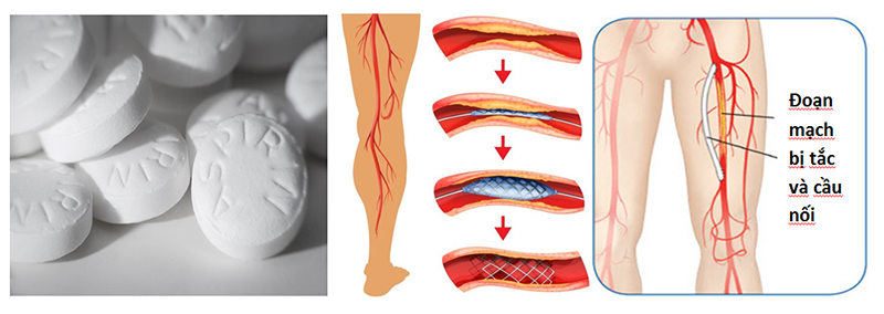 Cách điều trị bệnh động mạch ngoại biên 