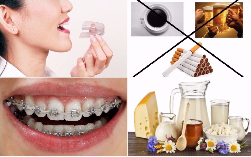 Nguyên nhân gây nghiên răng