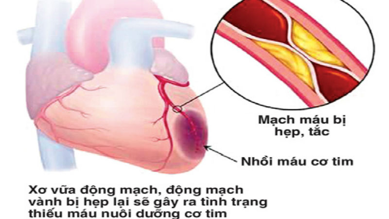 Các phương pháp điều trị hẹp mạch vành