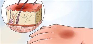 Thực phẩm có lợi cho vết thương bỏng