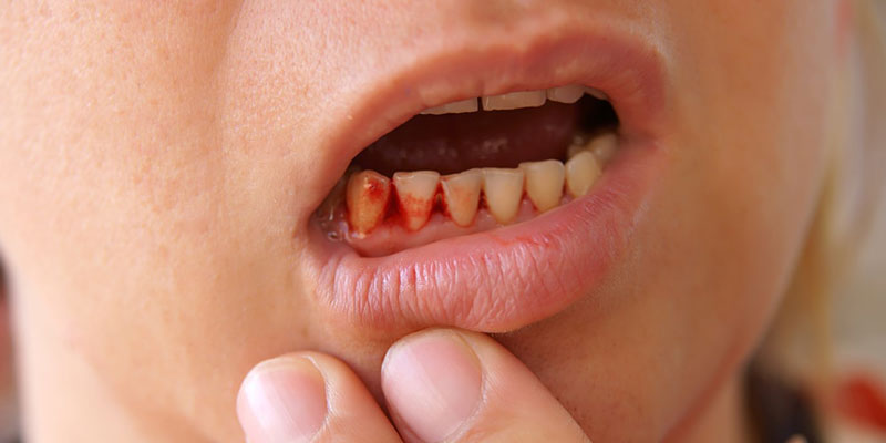 Bạn thường xuyên bị tình trạng chảy máu chân răng