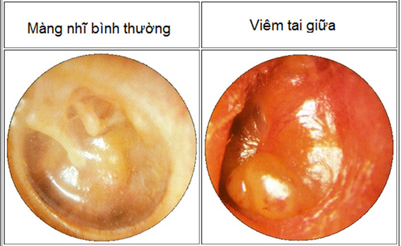 Viêm tai giữa hay nhiễm trùng tai giữa là tình trạng viêm và xuất hiện mủ ở vùng tai giữa