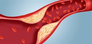 Chế độ ăn như thế nào là tốt cho người mắc rối loạn lipid máu?
