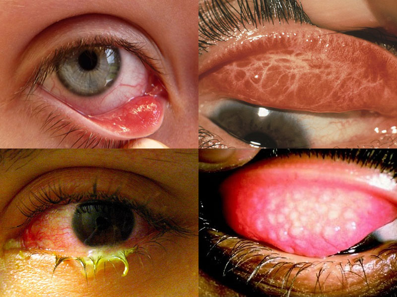 Triệu chứng của bệnh đau mắt hột