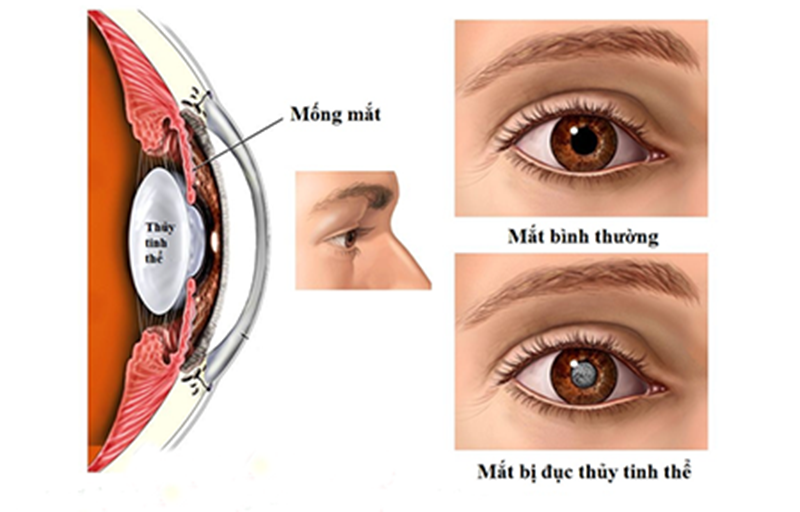 Đục thủy tinh thể, nguyên nhân, triệu chứng, điều trị