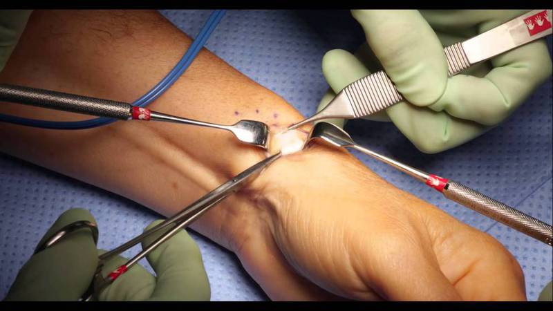 Phẫu thuật làm loại bỏ cơn đau và phục hồi phạm vi hoạt động của cổ tay.