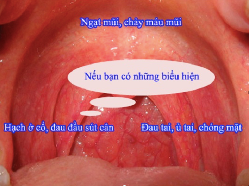 Ung thư vòm mũi họng, nguyên nhân, triệu chứng, điều trị