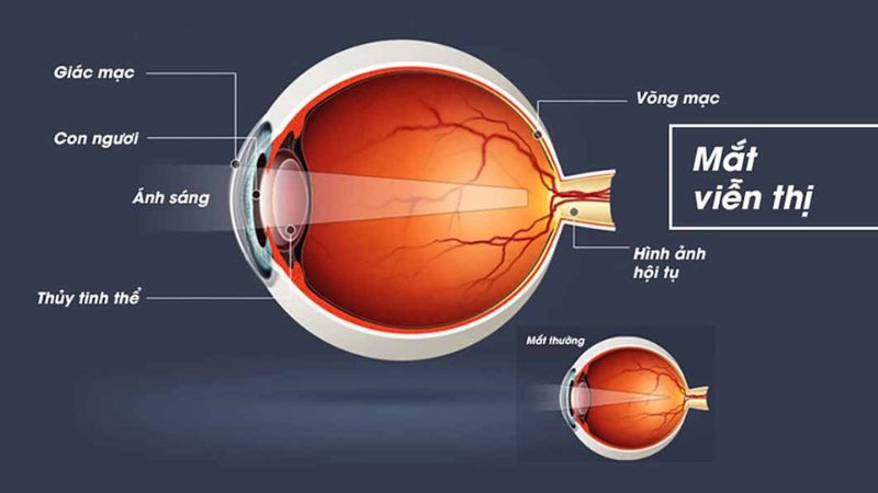 Viễn thị có khác lão thị? Nguyên nhân và cách điều trị mắt bị tật viễn