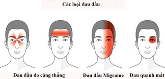 Tại sao lại có đau đầu migraine?
