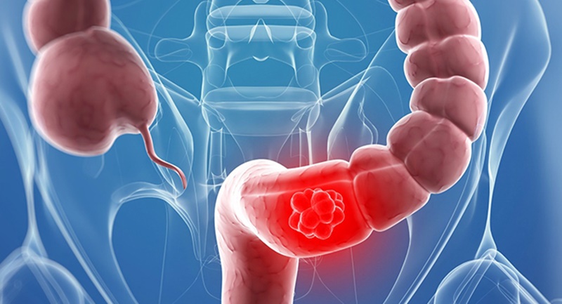 Người bị viêm đại tràng ăn bắp khiến thành ruột bị cọ xát nhiều, các vết loét đại tràng lan rộng hơn Người bị viêm đại tràng ăn bắp khiến thành ruột bị cọ xát nhiều, các vết loét đại tràng lan rộng hơn