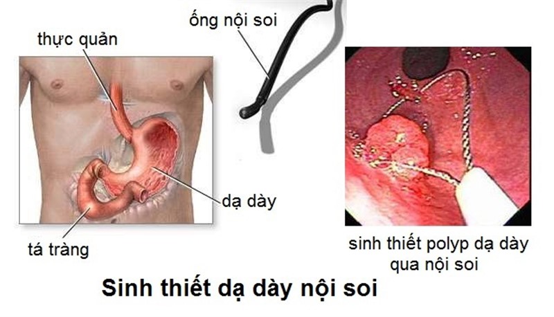 Polyp dạ dày, nguyên nhân, triệu chứng, điều trị