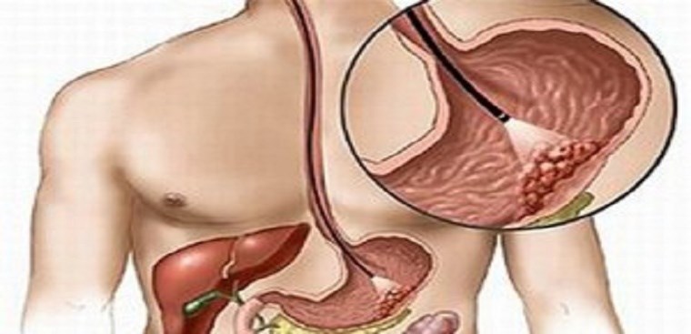 Tìm hiểu về polyp phình vị dạ dày và cách giảm đau hiệu quả