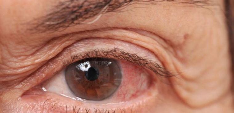 Glaucoma và bổ mắt: Glaucoma là một trong những căn bệnh đáng sợ của mắt, nhưng đừng quá lo lắng, vì việc bổ sung dinh dưỡng đúng cách có thể giúp ngăn ngừa và cải thiện bệnh tình. Đặc biệt, các loại thực phẩm giàu chất chống oxy hóa như trái cây, rau quả, hạt, và ức chế beta-glucan đều có tác dụng bổ mắt tuyệt vời.