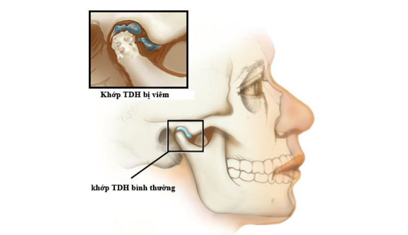 Nguyên nhân Rối loạn Thái Dương Hàm