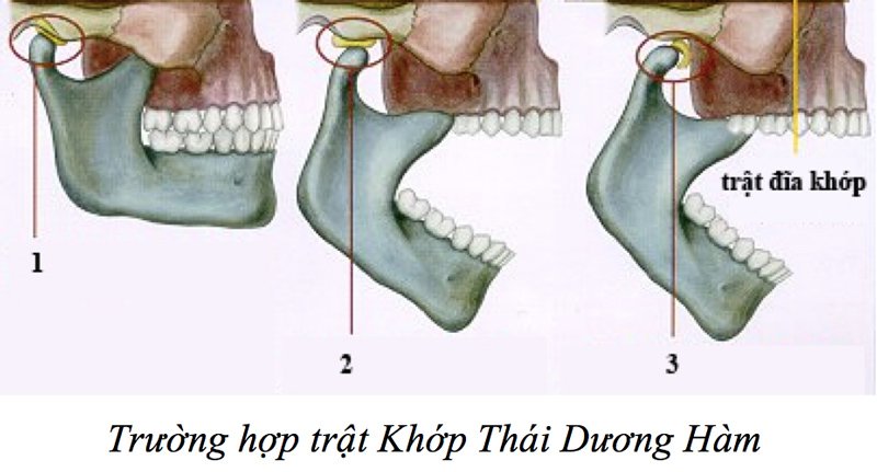 Nguyên nhân Rối loạn Thái Dương Hàm