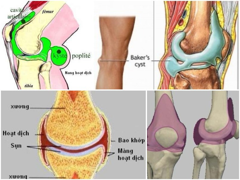 Viêm màng hoạt dịch là gì? Nguyên nhân, triệu chứng, điều trị