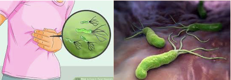 Vi khuẩn Helicobacter Pylori