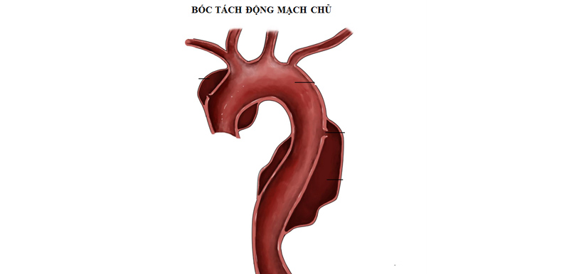 Bóc tách động mạch chủ