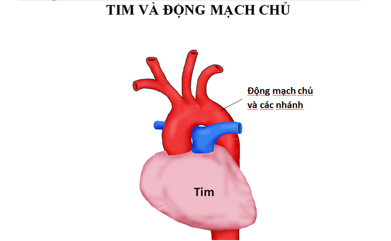 Bóc tách động mạch chủ là gì?