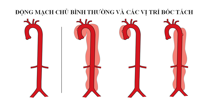 Bóc tách động mạch chủ là gì, nguyên nhân, triệu chứng, điều trị