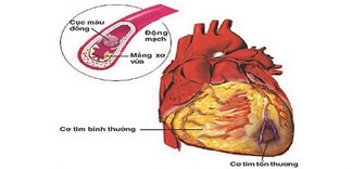 Tại sao phòng ngừa nhồi máu cơ tim quan trọng?
