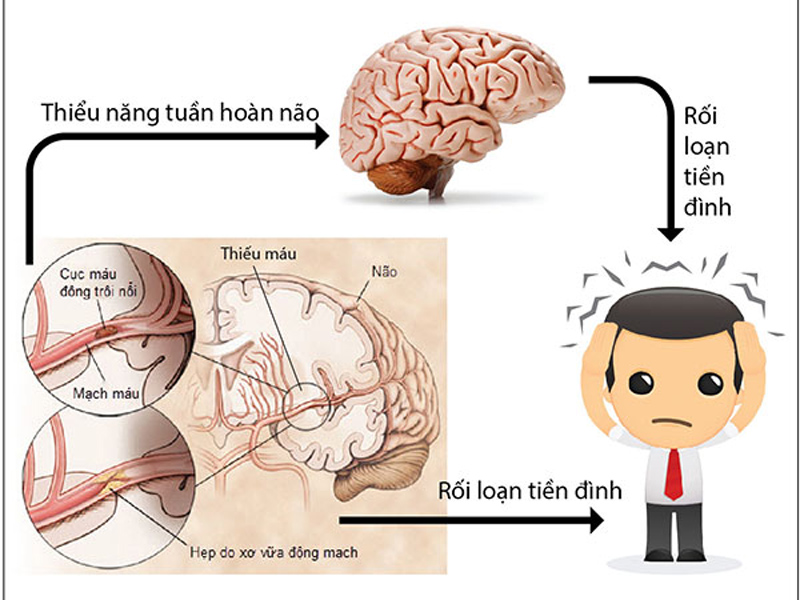 Nguyên nhân gây rối loạn tiền đình