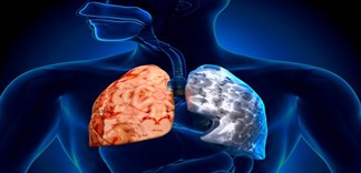 Cách phòng ngừa đợt cấp bệnh phổi tắc nghẽn mãn tính