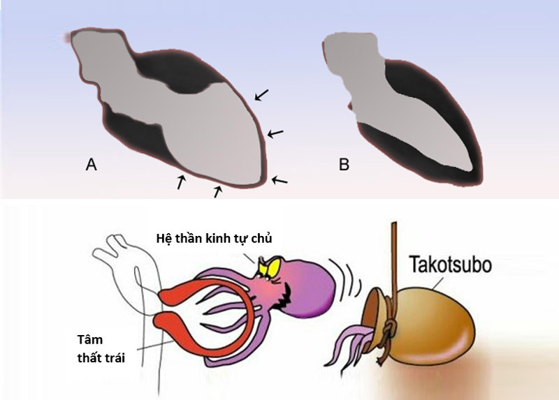 Bệnh Takotsubo là gì?