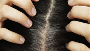 Nguyên nhân gây bạc tóc sớm ở nam giới  Vinmec